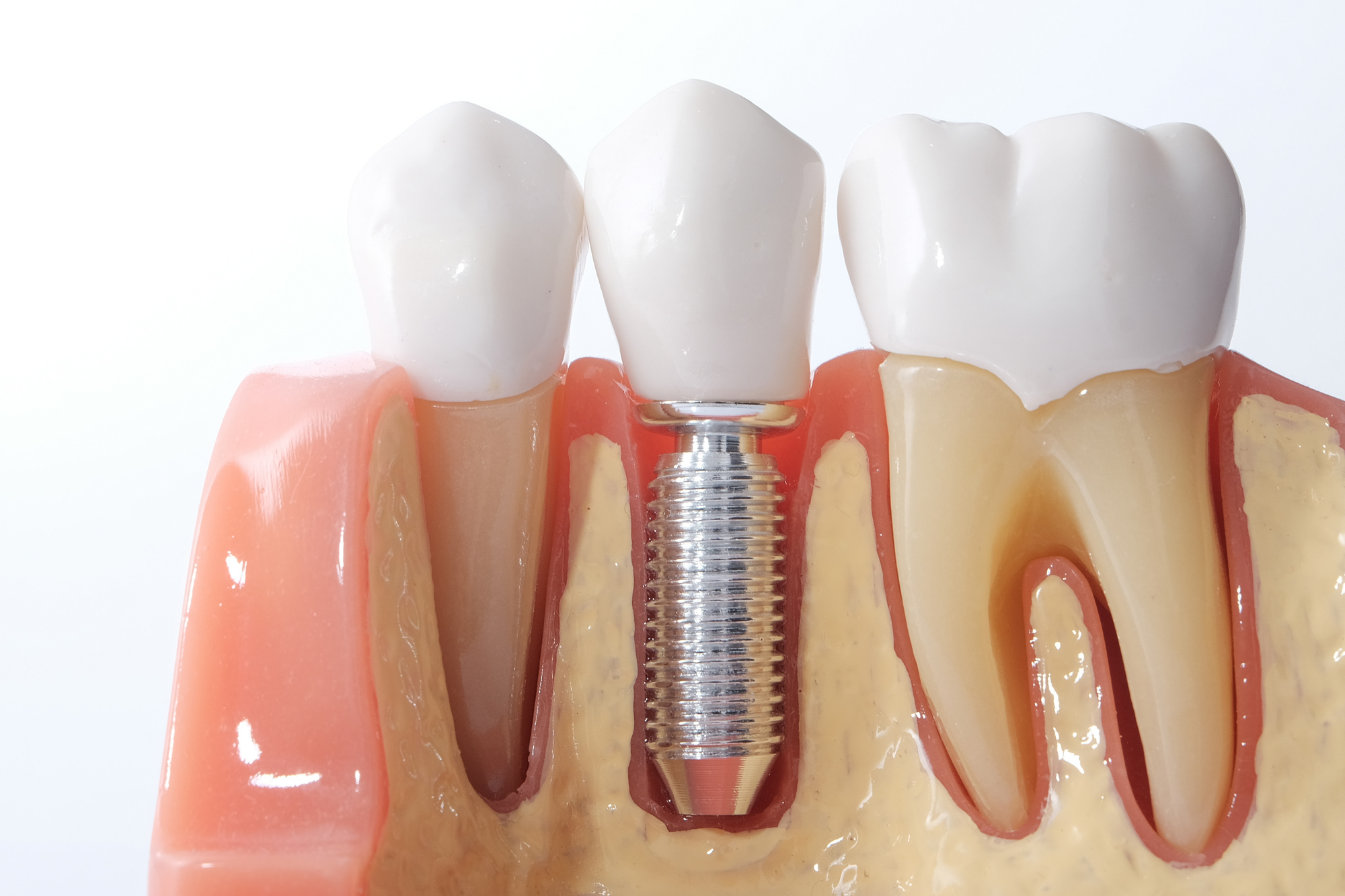 What Are Mini Dental Implants? A Quick Guide