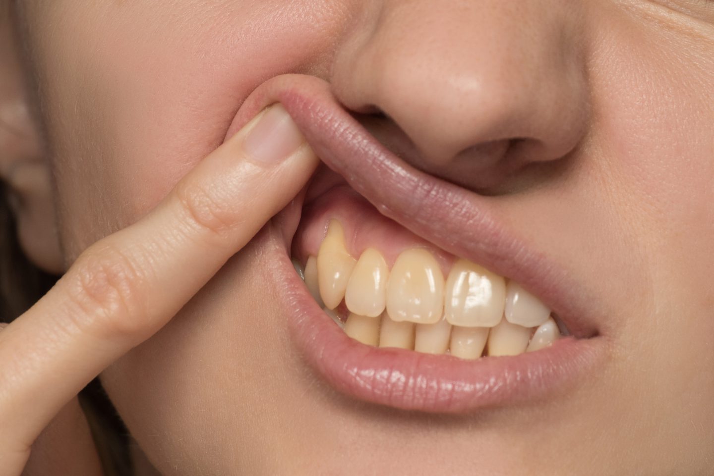 What Does Smoking Do to Your Teeth? Exploring the Link Between Tobacco and Gum Disease