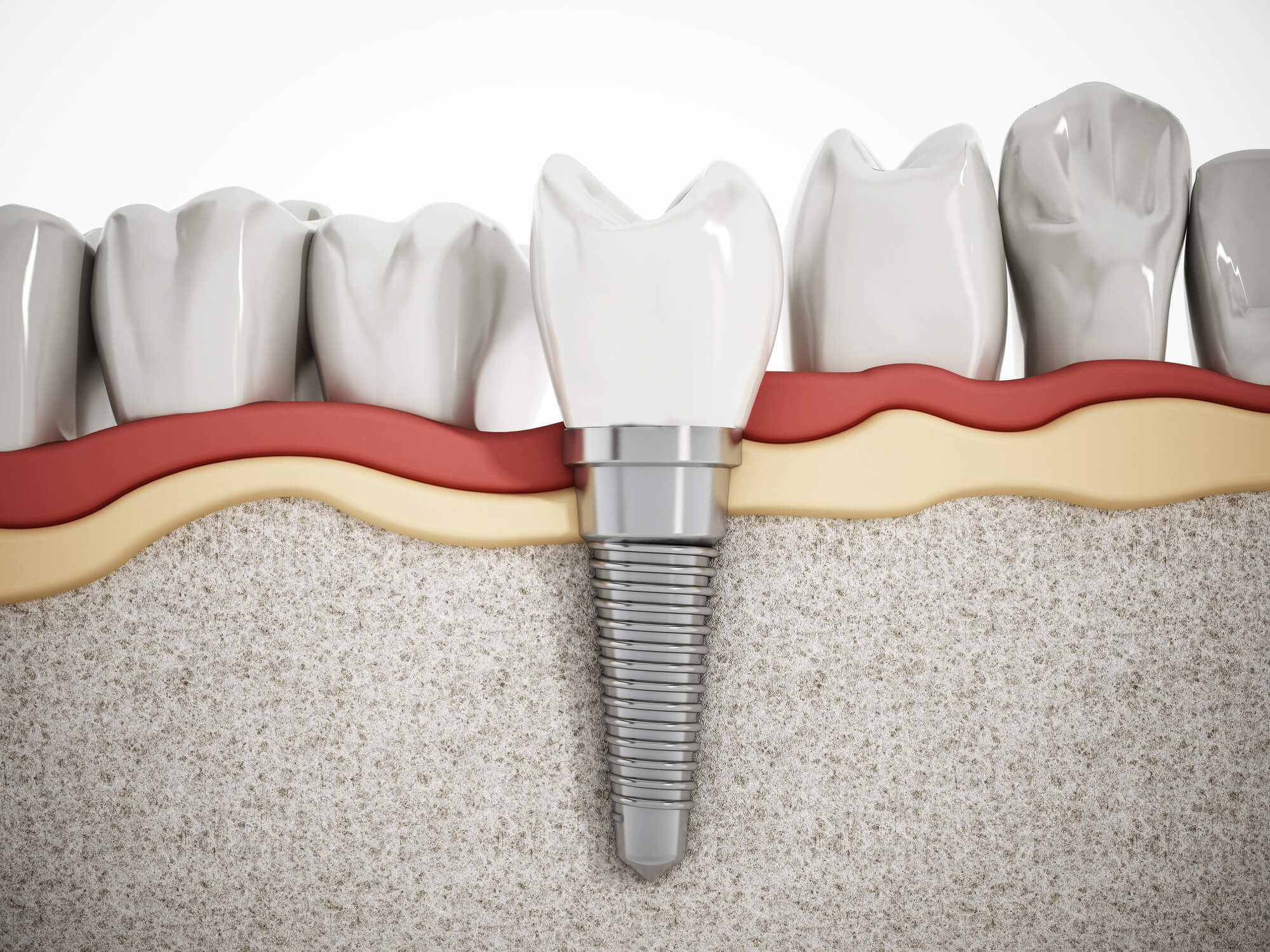 Tooth Talk: How Long Will My Mouth Be Sore After a Dental Implant?