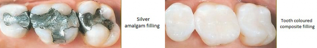 silver vs composite fillings