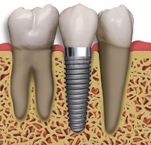 implant restoration